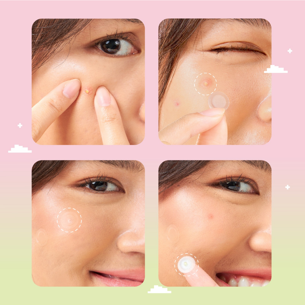 [ NEW ] True to Skin - Ready Acne Gone! Pimple Patch 15pcs Ultra Thin - Sticker penghilang jerawat dgn Centella Asiatica, Salicylic Acid, Tea Tree