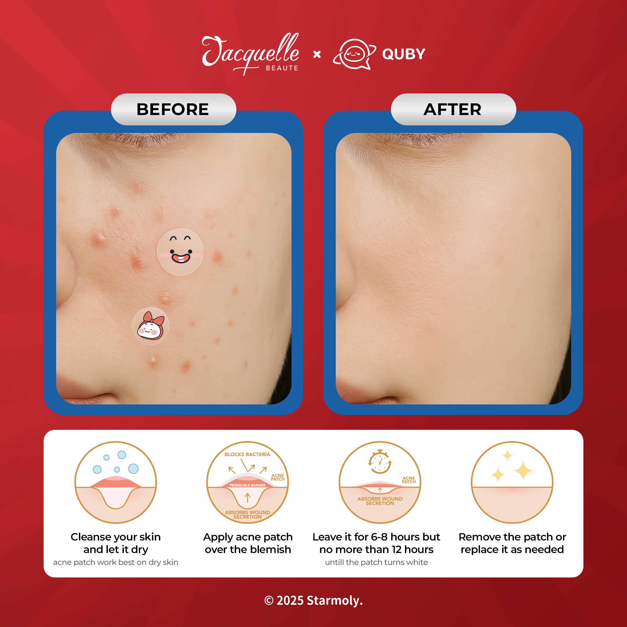Jacquelle Hydrocolloid Acne Patch - Quby Edition