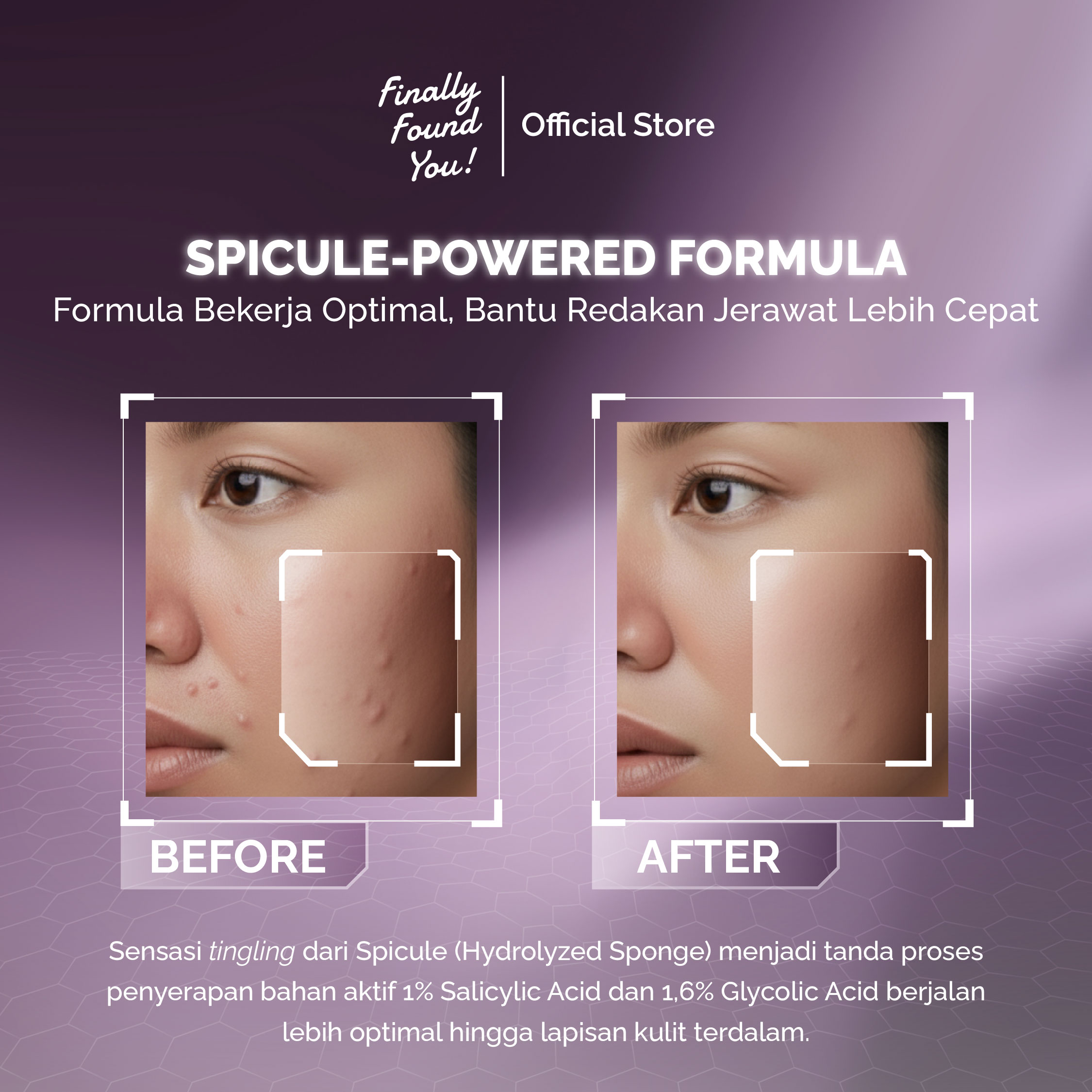 Finally Found You! Acne ProtecTea Spot Treatment 12g | Obat Totol Jerawat Untuk Kulit Sensitif & Berjerawat