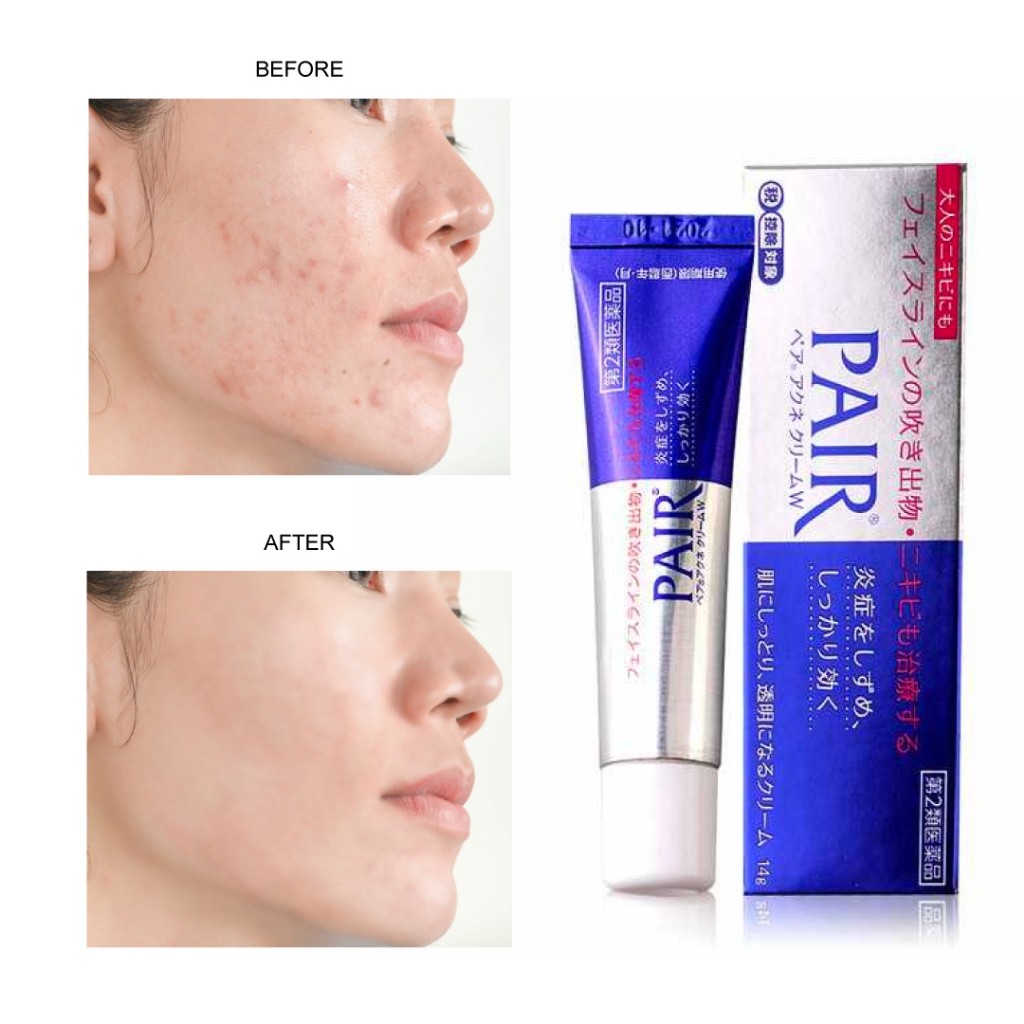 Lion Pair Acne 24g
