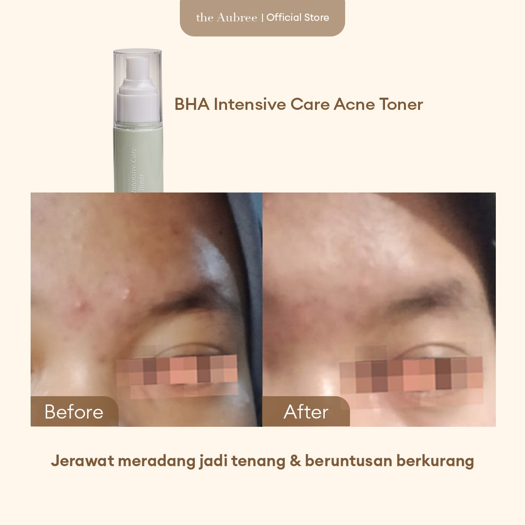 The Aubree BHA Intensive Acne Toner 50 ml Toner Anti Jerawat