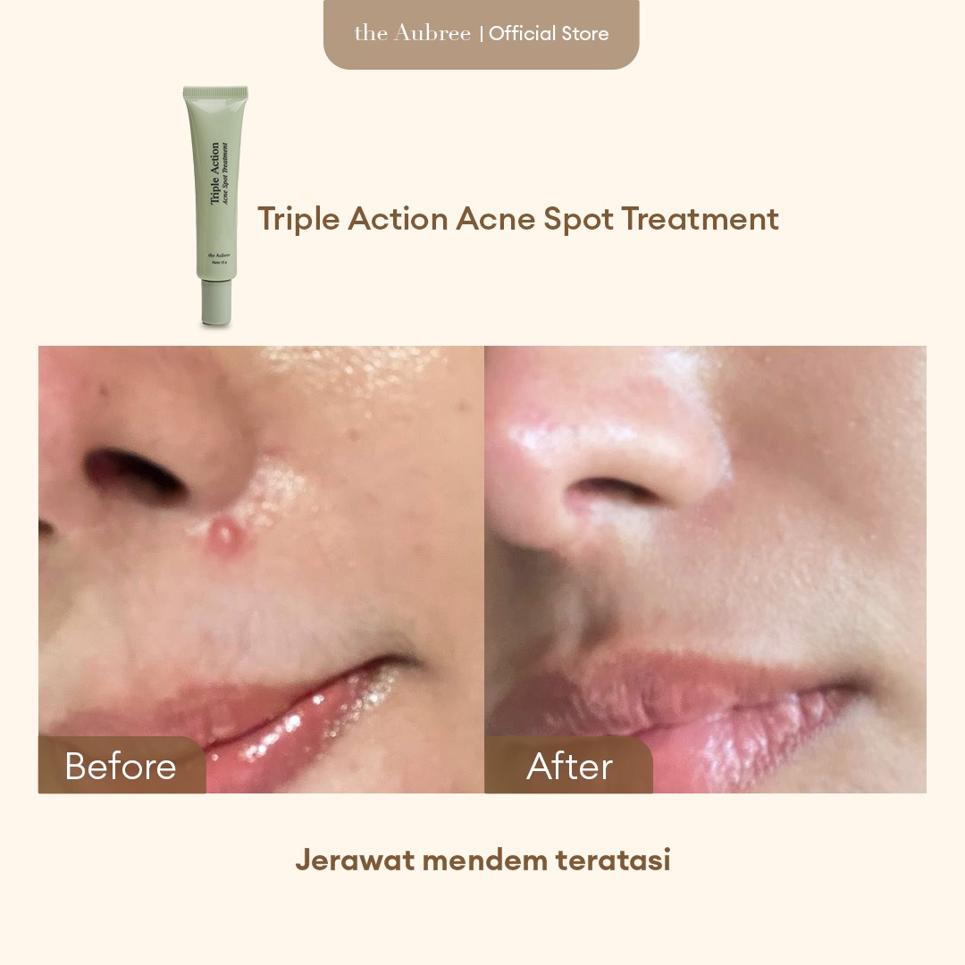 The Aubree
Triple Action Acne Spot Treatment 15 gr