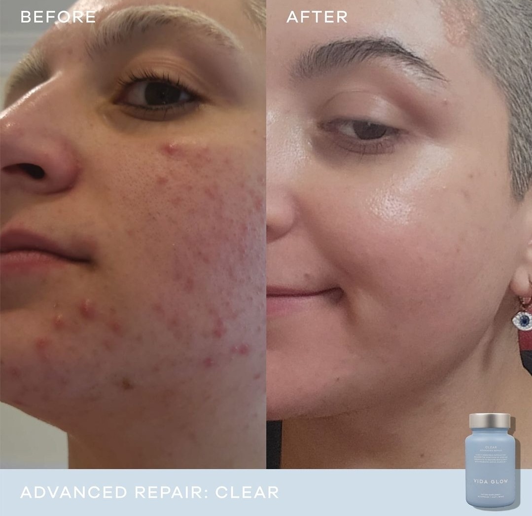 VIDAGLOW Clear Capsules for Acne Fighter
